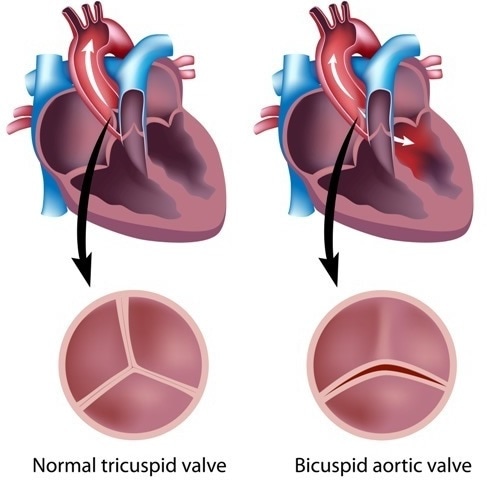 Heart valve defects. Image Credit: Alila Medical Media / Shutterstock